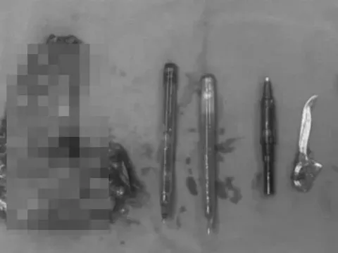 Mắc hội chứng kỳ lạ, người đàn ông nuốt cả bật lửa, bút bi, tăm nhựa vào bụng