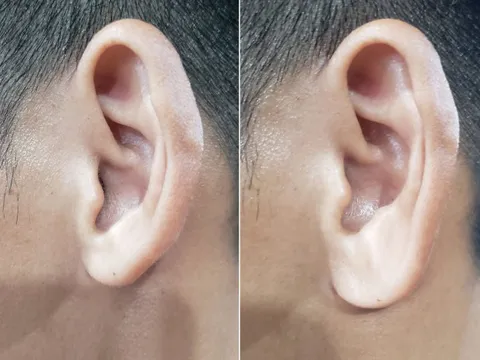 Có nên tiêm tai tài lộc?