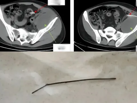 Chàng trai 28 tuổi đau bụng 3 tháng không đi lại được, đi khám bác sĩ "lôi ra" thứ dài 13cm từ trong bụng