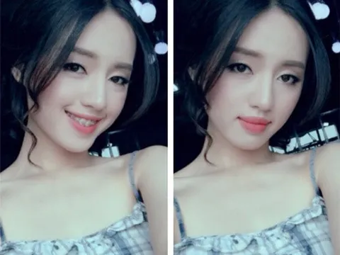 Có ai niềng răng xong bị lệch mặt không? Sự thật không hẳn như nhiều người vẫn nghĩ